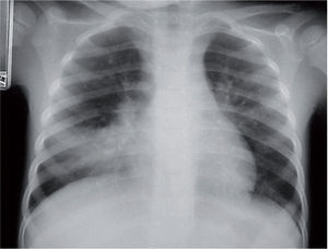 Aumento de densidad por ocupación del espacio aéreo limitado a un lóbulo en una neumonía por Mycoplasma pneumoniae.