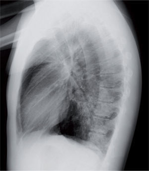 Infiltrado reticulonodulillar localizado en un solo lóbulo inferior en una neumonía por Mycoplasma pneumoniae.