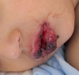 Síndrome de Stevens-Johnson en el curso de una infección por M. pneumoniae.
