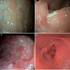 Imagen endoscópica en la enfermedad de Crohn. A) Úlceras aftoides. Áreas de mucosa respetadas. B) Úlceras irregulares abigarradas. C) Empedrado. D) Estenosis de píloro por inflamación y úlceras.