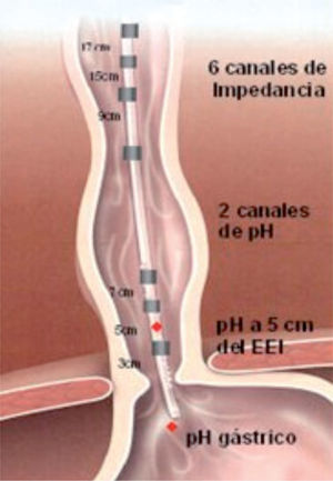 Sonda de impedancia intraluminal multicanal esofágica-pH-metría