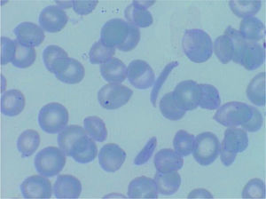 Drepanocitos o hematíes falciformes. Microfotografía (microscopía óptica ×100) de una extensión de sangre periférica en la que se pueden observar los hematíes alargados o falciformes, característicos de esta enfermedad.