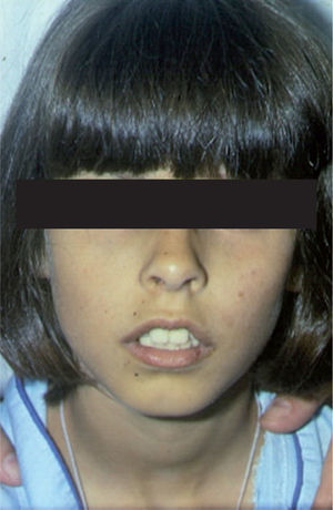 Pigmentación cutánea anómala en una niña con insuficiencia suprarrenal. Posteriormente desarrolló un síndrome pluriglandular autoinmune.