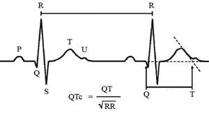 Medición del intervalo QTc: se utiliza la fórmula de Bazett para corregir la duración del intervalo de acuerdo con la frecuencia cardiaca. Debe medirse preferentemente en II y en V5 o en la derivación en que parezca ser más largo. Debe delimitarse el final de la onda T, con ayuda del método de la tangente como se muestra en la figura25, con respecto a la onda U. El QT medido de esta manera se divide entre la raíz cuadrada del intervalo RR precedente. Velocidad: 25mm/s; 1mm = 0,04s. De forma rápida: se debe sospechar QT largo cuando la onda T supera la mitad del intervalo RR o bien cuando se «monta» sobre la onda P del siguiente ciclo cardiaco.