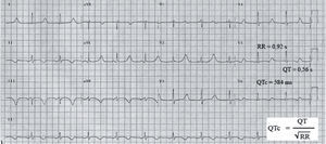 Registro electrocardiográfico de paciente varón con síndrome de QT largo y diagnóstico previo de epilepsia (1mm=0,04s). QT medido en V5: 14mm×0,04s=0,56s; RR precedente: 23mm×0,04s=0,92s; raíz cuadrada de 0,92=0,959; QTc=QT medido/raíz cuadrada del RR precedente = 0,56/0,959=0,584s=584ms.