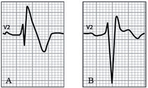 Síndrome de Brugada (Corrado D. Recommendations for interpretation of 12-lead electrocardiogram in the athlete. Eur Heart J. 2010;31:243–59). A) Patrón electrocardiográfico tipo 1. Elevación del ST ≥ 2mm con inversión de la onda T («aleta de tiburón»). B) Patrón electrocardiográfico tipo 2. Elevación del ST ≥ 2mm con onda T isodifásica («silla de montar»).