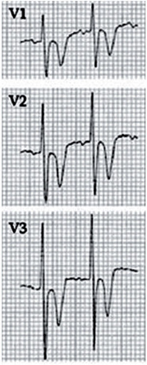 Detalle del registro electrocardiográfico de paciente de 2 años estudiado por episodio de muerte súbita abortada a los 4 meses y diagnosticado de síndrome de QT corto. Presenta un intervalo QT llamativamente corto (210ms) y un QTc de 324ms. Apenas existe intervalo ST y presenta ondas T negativas muy picudas32.