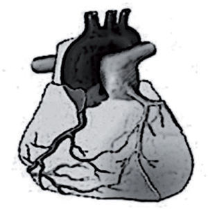 Origen anómalo de la arteria coronaria izquierda en la arteria pulmonar. Las resistencias pulmonares elevadas características del período fetal permiten la perfusión anterógrada de la coronaria izquierda a partir de la arteria pulmonar. Después del parto, las resistencias pulmonares empiezan a bajar y sobre los 2 meses de vida ya alcanzan los niveles del adulto. En esta situación hemodinámica, el flujo de la coronaria anómala se invierte y se dirige hacia el tronco pulmonar robando el flujo procedente de las colaterales y produciendo isquemia de la cara anterolateral del ventrículo izquierdo.