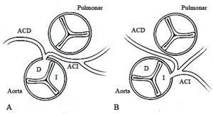 A) Origen anómalo de la arteria coronaria izquierda (ACI) en el seno de Valsalva derecho. B) Origen anómalo de la arteria coronaria derecha (ACD) en el seno de Valsalva izquierdo. El recorrido obligado entre las dos grandes arterias junto con anomalías frecuentes asociadas como la forma del ostium (en forma de hendidura), el origen en ángulo agudo, pueden determinar alteraciones de la perfusión coronaria que se ponen de manifiesto sólo en momentos de máximo esfuerzo.