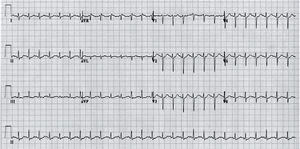 Registro electrocardiográfico de lactante varón de 3 meses con diagnóstico de miocarditis aguda. La taquicardia sinusal y los cambios inespecíficos del segmento ST y de la onda T (ligero descenso del ST con ondas T aplanadas) constituyen los hallazgos más frecuentes.