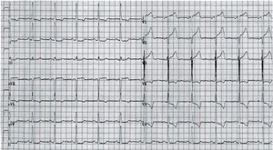 Registro electrocardiográfico de niña de 12 años con diagnóstico de estenosis aórtica valvular. La presencia de descenso del ST (V5 y V6) con ondas T negativas (aVL, V5 y V6) traduce hipertrofia ventricular izquierda grave con isquemia latente.