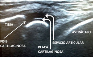 Corte longitudinal anterior en artritis de tobillo. La línea de interfase hiperecoica delimita la placa cartilaginosa de la epífisis tibial respecto al espacio articular que se encuentra aumentado por derrame (ambos hipoecoicos). La fisis de la tibia interrumpe la cortical ósea.