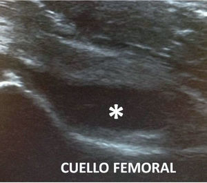 Corte longitudinal anterior en sinovitis transitoria de cadera. Muestra la cápsula articular abombada por el derrame (*).