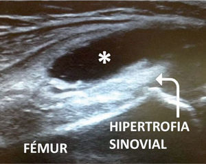 Corte longitudinal suprapatelar en artritis de rodilla. El derrame articular rellena el receso (*) y la hipertrofia sinovial aparece hiperecoica respecto al derrame.