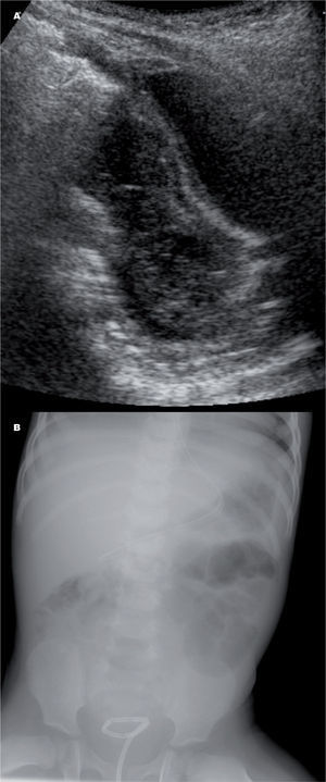 A) Ecografía pélvica en la que se demuestra un absceso (a) entre la vejiga (v) y el recto (r). B) Radiografía de abdomen tras la colocación del catéter de drenaje transrectal.