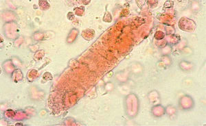 Sedimento de características glomerulares. Hematíes dismórficos. Cilindro granuloso.