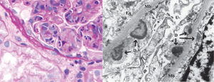 Glomerulonefritis aguda postestreptocócica. Microscopia óptica, tinción hematoxilina-eosina en la que se puede ver proliferación difusa. Microscopia electrónica: jorobas. D: depósitos subepiteliales o jorobas; En: endotelio; Mb: membrana; P: podocito; U: espacio urinario.