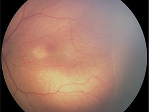 ROP grado 1: línea de demarcación entre retina vascular y avascular.