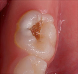 La caries se manifiesta con lesiones normalmente progresivas que, si no se tratan, aumentarán de tamaño, progresando hacia la pulpa dentaria.