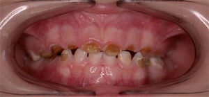 La caries de la primera infancia, cuyas consecuencias son rápidas y muy devastadoras.