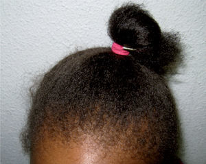 Alopecia traumática.