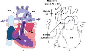 Representación del síndrome de hipoplasia de cavidades izquierdas (1) y la cirugía de Norwood clásico (2). Ao: aorta; Pu: pulmonar; SP: sistémico-pulmonar (de aorta a ramas pulmonares).