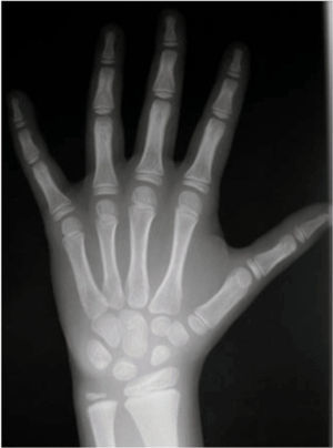 Radiografía posteroanterior de mano y muñeca izquierdas.