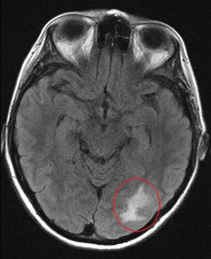 Resonancia magnética, corte axial: infarto venoso occipital izquierdo.