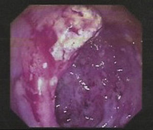 Úlceras en colon ascendente con marcada friabilidad.
