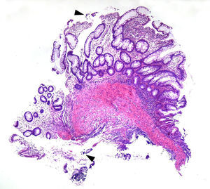 Histología: estructuras parasitarias PAS positivas, infiltrado linfoplasmocitario (biopsia de colon).