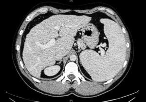 Hígado de bordes nodulares y signos de hipertensión portal (dilatación de la vena porta y esplenomegalia).