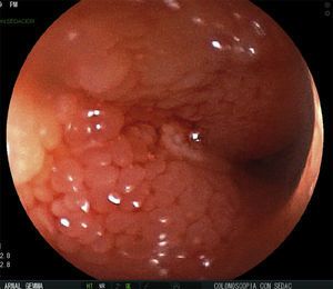 Úlcera milimétrica y patrón mucosa granular del íleon distal.