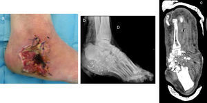 a: pie después de lavado pulsátil en el quirófano. b: radiografía a su llegada a Urgencias. c: TC posterior a la primera cirugía de limpieza y desbridamiento.