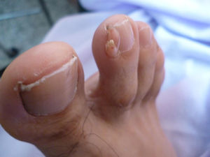 Pueden apreciarse 2 dedos supernumerarios en la cara medial de la falange distal del segundo dedo del pie derecho.