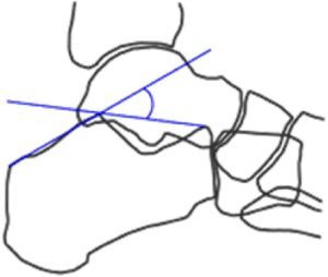 Ángulo de Böhler: 25-40°.