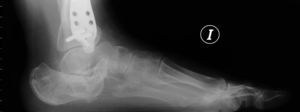 Radiografía lateral de mala consolidación tipo ii. Obsérvese el astrágalo en dorsiflexión y el aplanamiento del ángulo de Böhler.