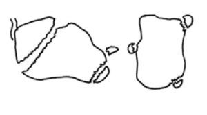 Fractura en «pico de pato» y del proceso anterior (izqda.) y fractura del tubérculo interno y del sustentaculum tali aislado (dcha.).