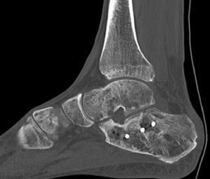 TC postoperatoria del mismo caso: restitución de subastragalina posterior.