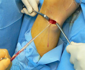 Extracción del autoinjerto de semitendinoso con un tenotomo. En este caso el injerto de recto interno fue muy corto y no pudo ser aprovechado.