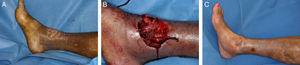 A. Defecto de 5cm en el maléolo interno y la región supramaleolar con exposición de foco de fractura. B. Detalle intraoperatorio del colgajo muscular extensor corto de los dedos. C. Resultado al año.