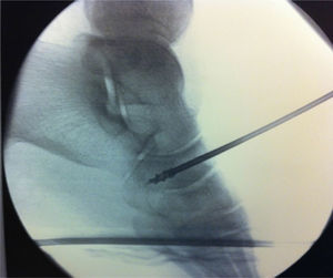 Imagen de escopia intraoperatoria del labrado en túnel, y del arpón en el escafoides tarsiano para la reinserción del tendón tibial anterior.