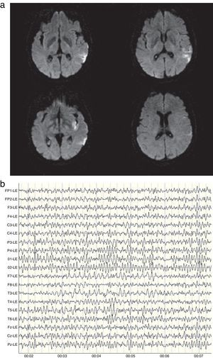 RH’ CT brain scan (a) and Monopolar EEG fragment (b).