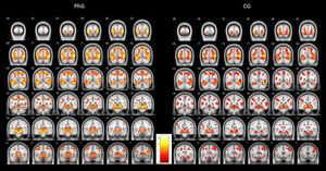 Graphical representation of differential brain activations of phobic group (PhG) versus non-phobic control group (CG).