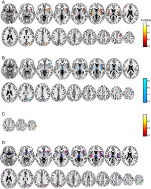 Brain grey matter volumes significantly associated to pain scores at Anesthesia (A), Pain (B), and Analgesia (C) stages. Scales indicated the t-values. Overlap (D) of these associations (red: positive, anesthesia stage; blue: negative, pain stage; green: positive, analgesia stage; magenta indicate anesthesia-pain overlapping).