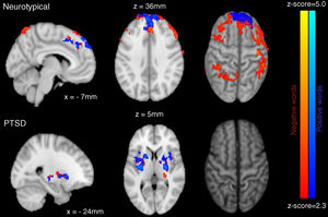 Sagittal (left) and axial (middle), and cortical (right) views of between group activation for NT (top) and PTSD (bottom) participants for negative (orange) and positive (blue) words.