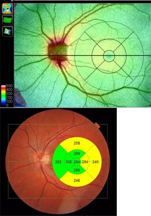Scan of the macular acquisition with optical coherence tomography (OCT). The figure shows the 9 regions defined by the Early Treatment Diabetic Retinopathy Study (ETDRS) chart.