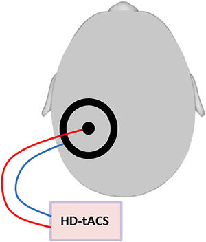 Schematic figure of the HD-tACS set-up: HD-tACS was performed using a small circular (diameter: 2.1 cm, thickness: 2 mm) and a large (outer diameter: 11 cm; inner diameter: 9 cm, thickness: 2 mm) rubber ring tACS electrode (NeuroConn, Ilmenau, Germany) that were both placed onto the contralesional posterior parietal cortex, with the small electrode positioned over P3 or P4 (based on the international 10–20 EEG system) and the large electrode centered on it.