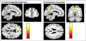 Group-level analyses of the Default Mode Network (DMN). Brain regions are showing a significant effect of the empathy response categories in the attenuation pattern of the DMN (i.e., the comparison of each empathic category with the two other). A - shows the result from a t-test comparing interchangeable with subtractive and additive responses (i.e., interchangeable < subtractive and additive). B - shows the result from a t-test comparing subtractive with interchangeable and additive responses (i.e., subtractive < interchangeable and additive). Additive empathy response conditions showed no significant attenuation of DMN areas when compared with subtractive and interchangeable responses. The color bar shows the T value thresholded at p < .05 corrected for multiple comparisons.