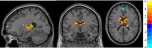 DC analysis. Two-sample t-test results corrected by TFCE are presented. The area in blue represents a significantly decreased DC value in DS patients compared with controls; the area in yellow and red represents a significantly increased DC value in DS patients compared with controls.