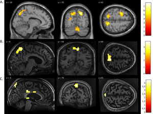 FMRI activation observed during the spatial navigation imagery task for a group of healthy participants (A) and two completely locked-in GBS patients (B and C). (A) In healthy participants, a whole-brain group analysis revealed significant activation in the occipito-parietal junction, cerebellum, parahippocampal gyrus, and left middle frontal gyrus using a threshold of p < .05, FDR-corrected for multiple comparisons. Group analysis is shown on a canonical single-subject T1 MRI image. (B) In patient 1 a whole-brain analysis revealed significant activation in the occipito-parietal junction with results displayed at a peak voxelwise threshold p < .001, uncorrected followed by whole-brain FDR-corrected for significance using cluster extent, p < .05 and displayed on the patient